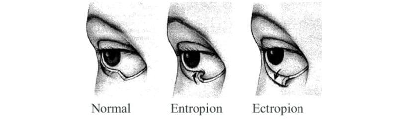abnormality očních víček
