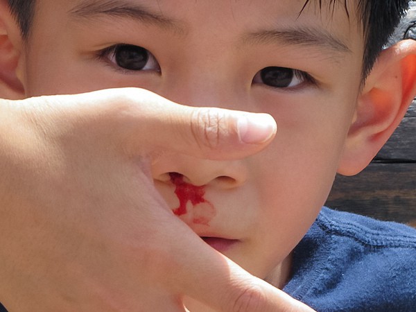 krvácení z nosu u dětí