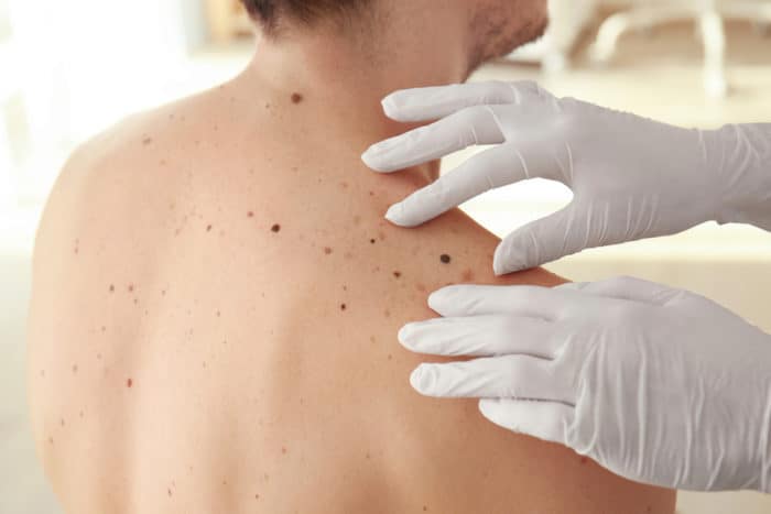 rakovina kůže melanomu