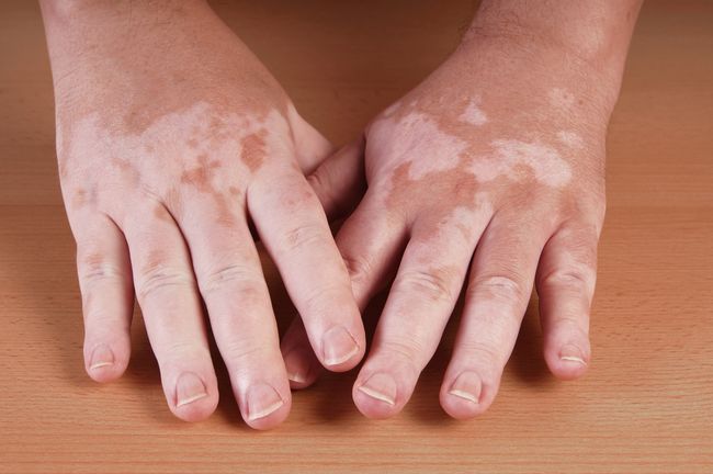 vitiligo se může léčit