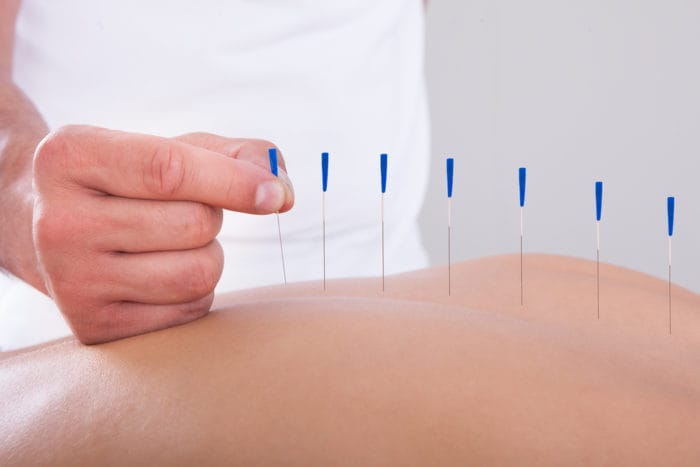 akupunktura zmírňuje bolest