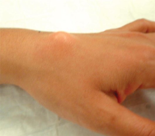 Kožní gangliová zápěstí na zápěstí (zdroj: Americká společnost pro chirurgii rukou)