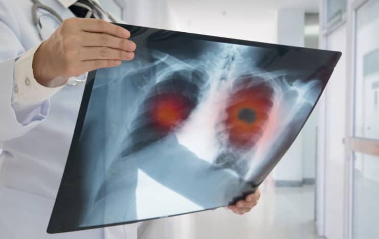 rizikových faktorů pro rakovinu plic