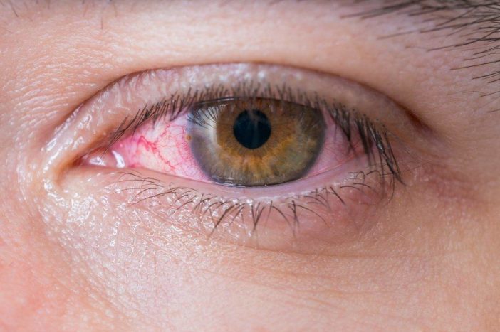 alergické červené oční konjunktivitidy