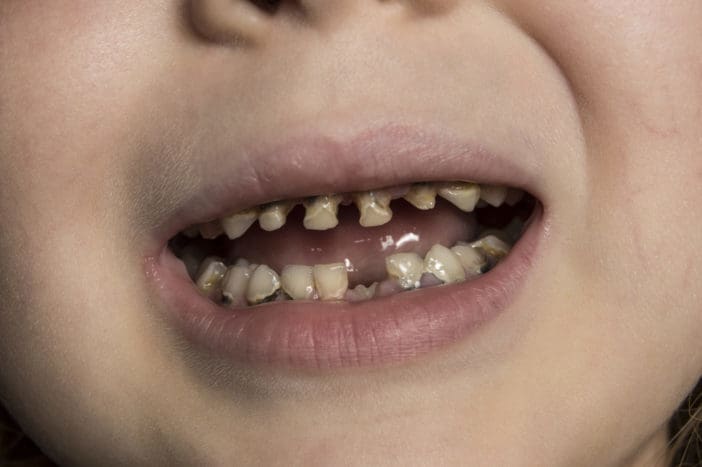 zubní kaz na dětské zuby