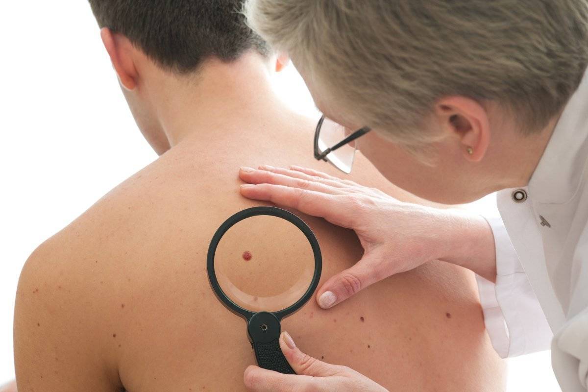 zdravotní fakta melanomových krtků