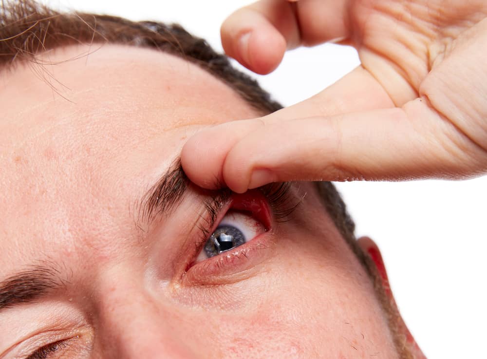 syndrom dýchavého očního víčka