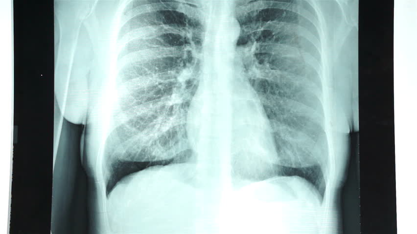 rentgenové vyšetření hrudníku