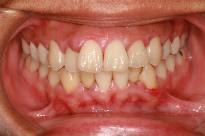 krvácející dásně