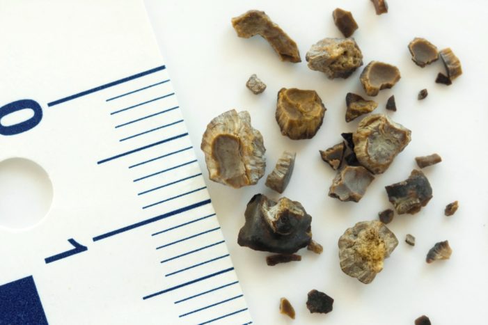 ledvinové kameny a žlučové kameny