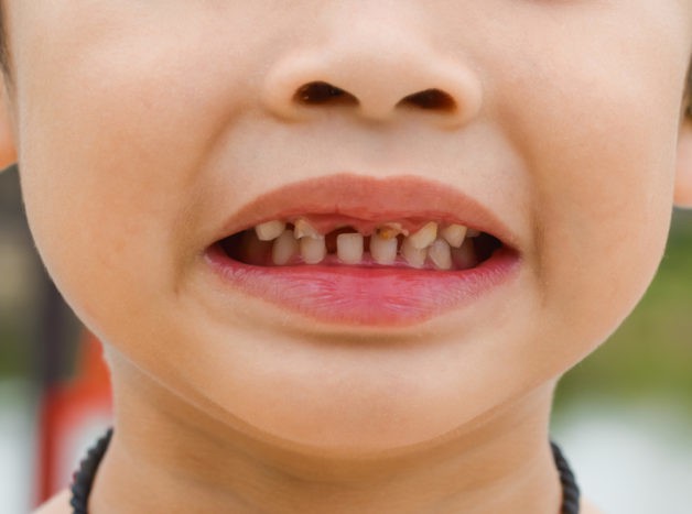 poškození zubů dětí