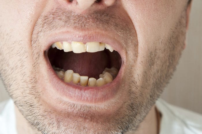 jak zabránit zubnímu kamení