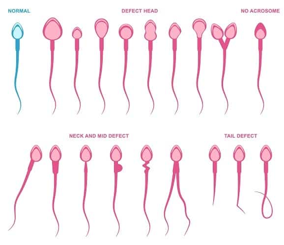 abnormality spermií